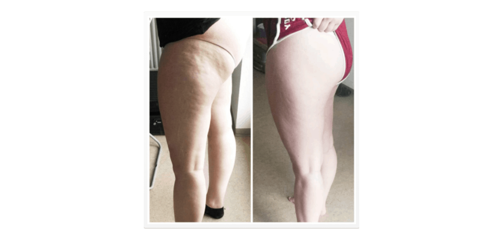 My Cellulite Solution results