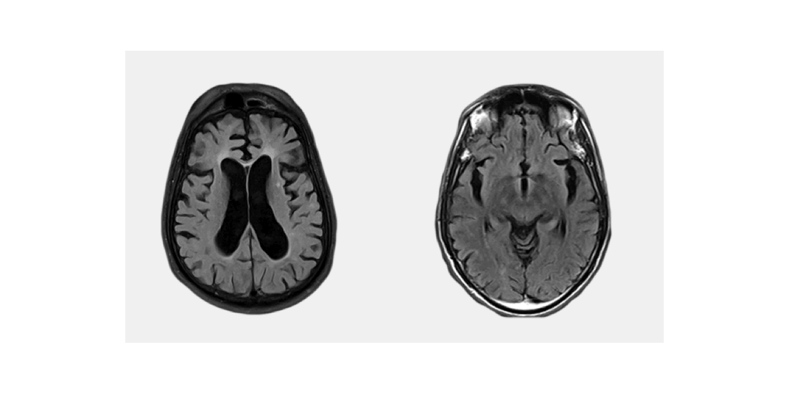 ProMind Complex supplement for brain