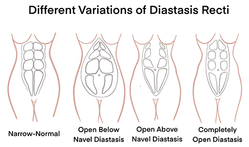 Diastasis Recti - Pelvic Floor Strong