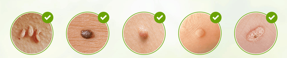 Skincell Pro Skin tag removal