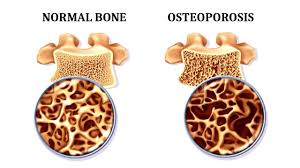 The-Bone-Density-Solution-book