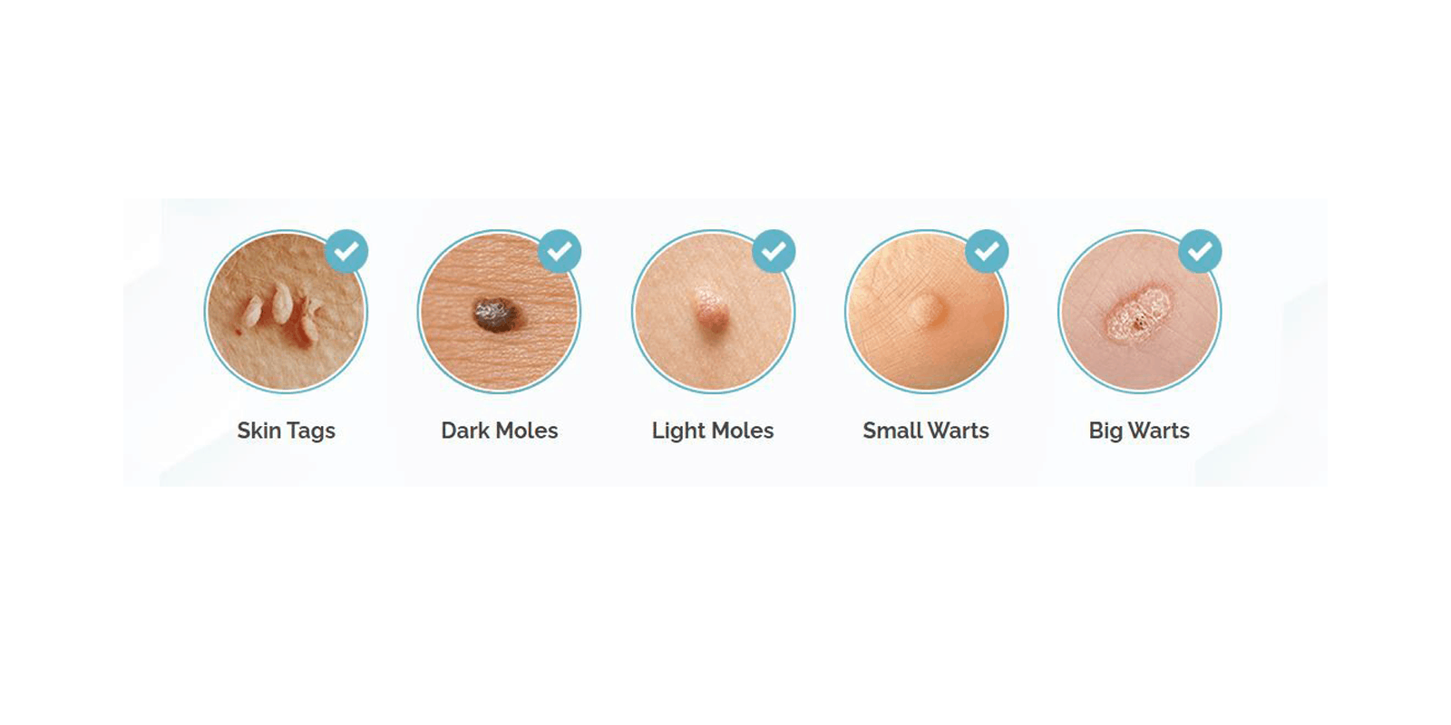 Skincell Advanced Skin Tag removal