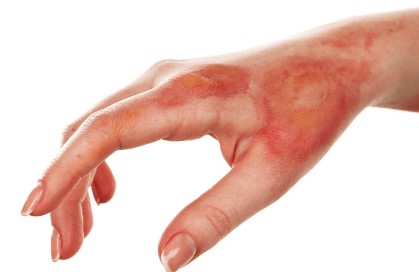 Light Therapies Heals Burn Injuries Quick By Activating Protein Growth