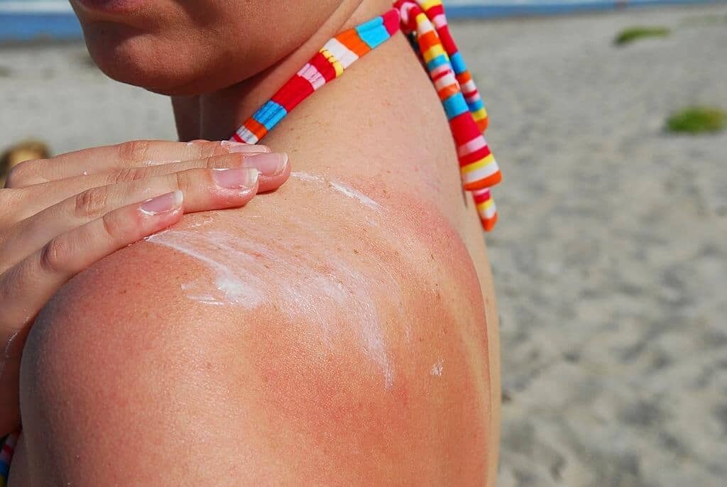 Sunburn Consultations Are Rare