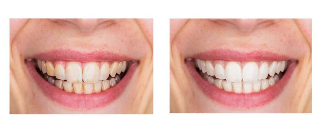 dentitox pro before and after images