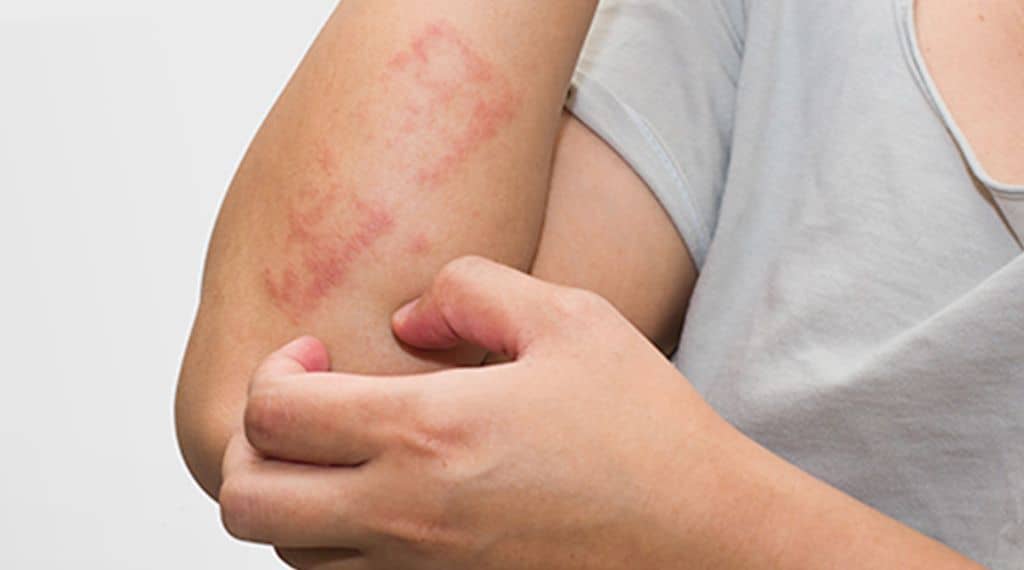 Signs And Symptoms Of Toddler Eczema, As Well As Therapy