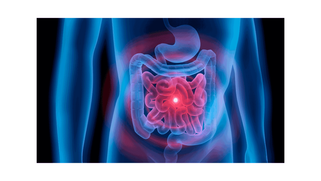 Acid Reflux 911 - Digestive Problems