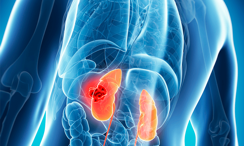 In Preclinical Models, Genetic Kidney Disease Is Reversible