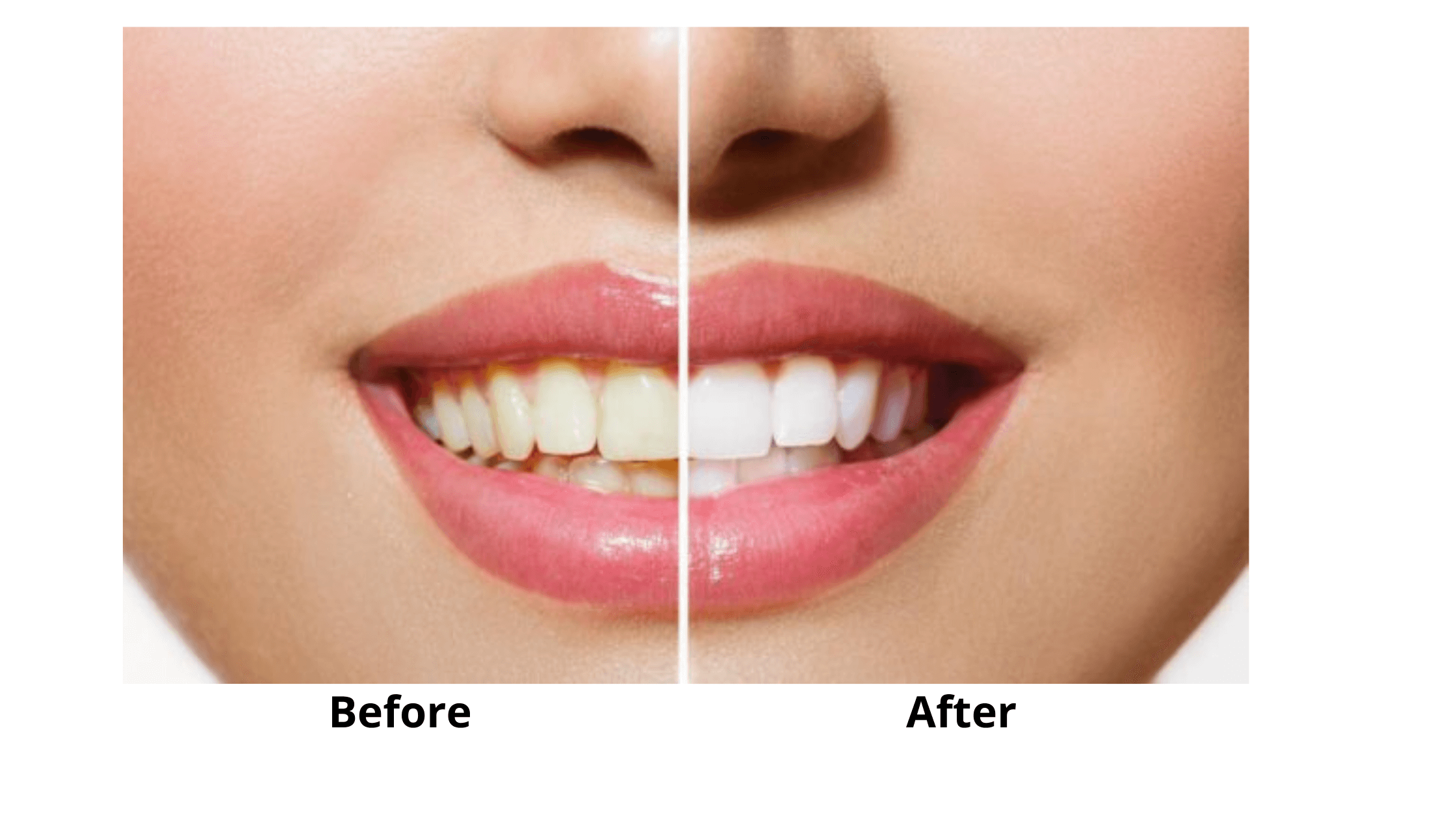 HiSmile Results