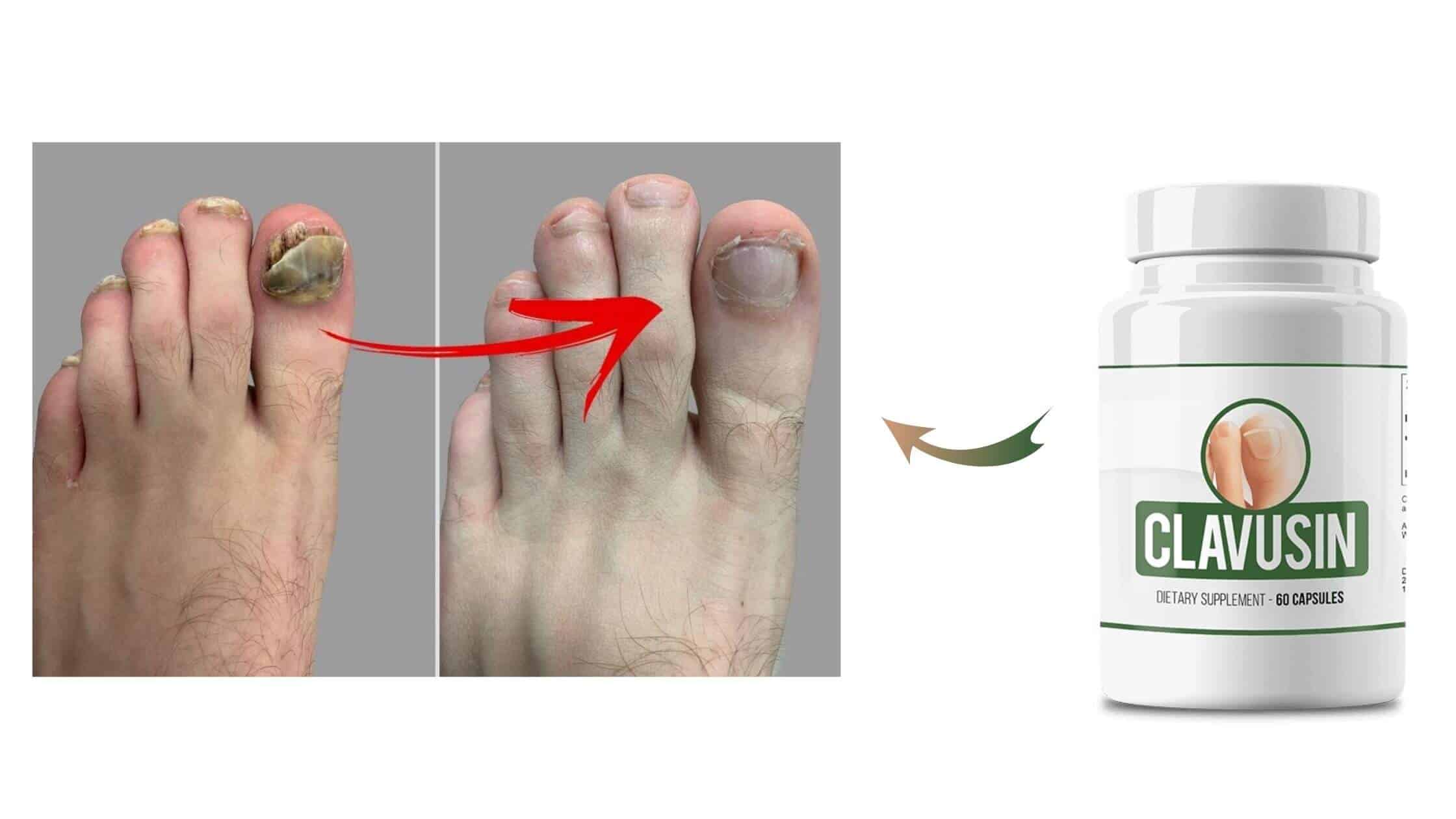 Clavusin Result