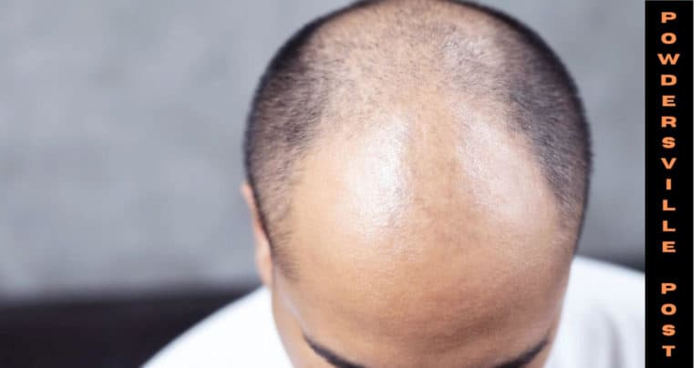 Hair Loss In Males And The Best Treatment: Latest News!