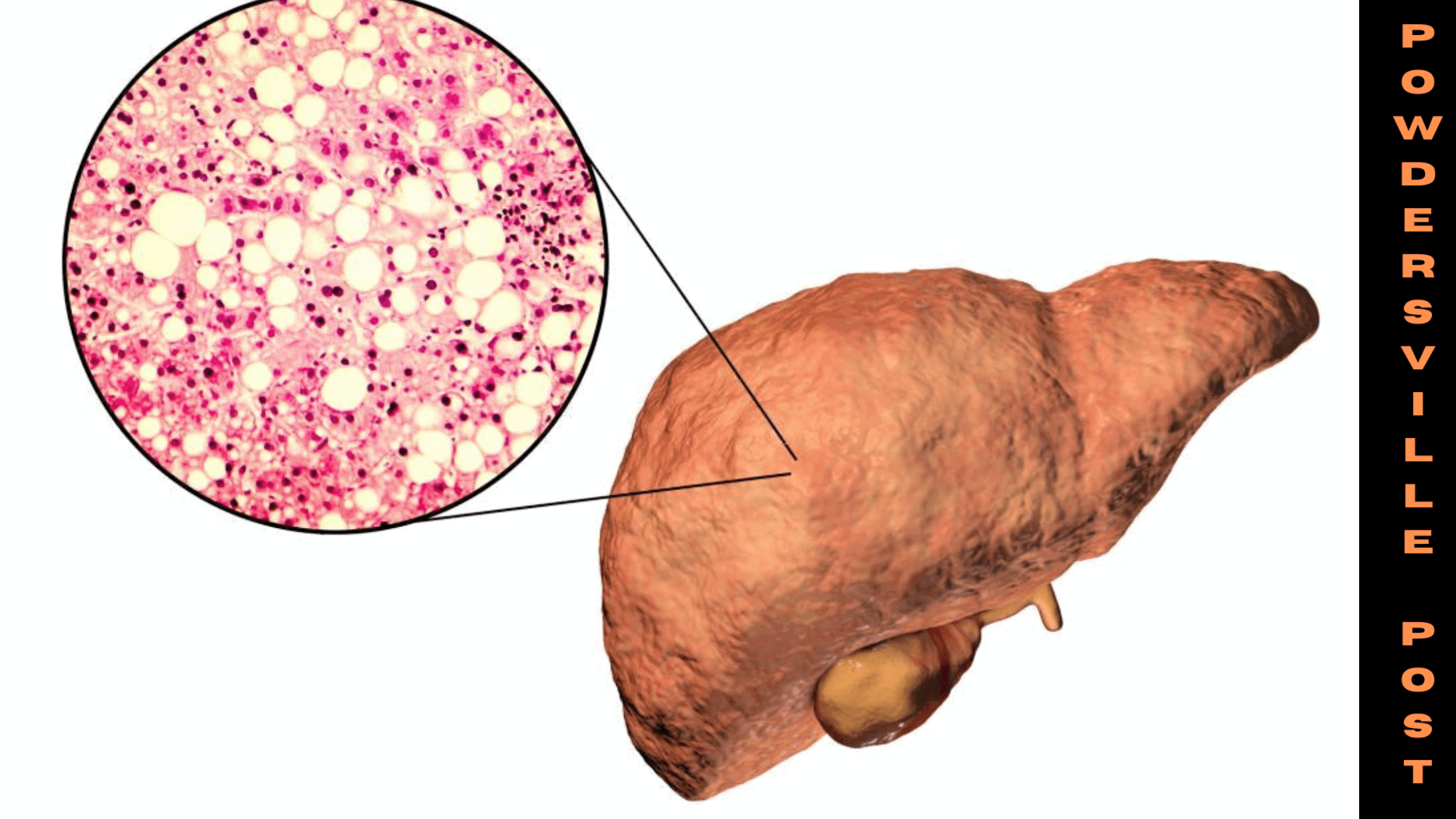 Clotting Risk In Non-alcoholic Fatty Liver Patients Reduces With Exercise