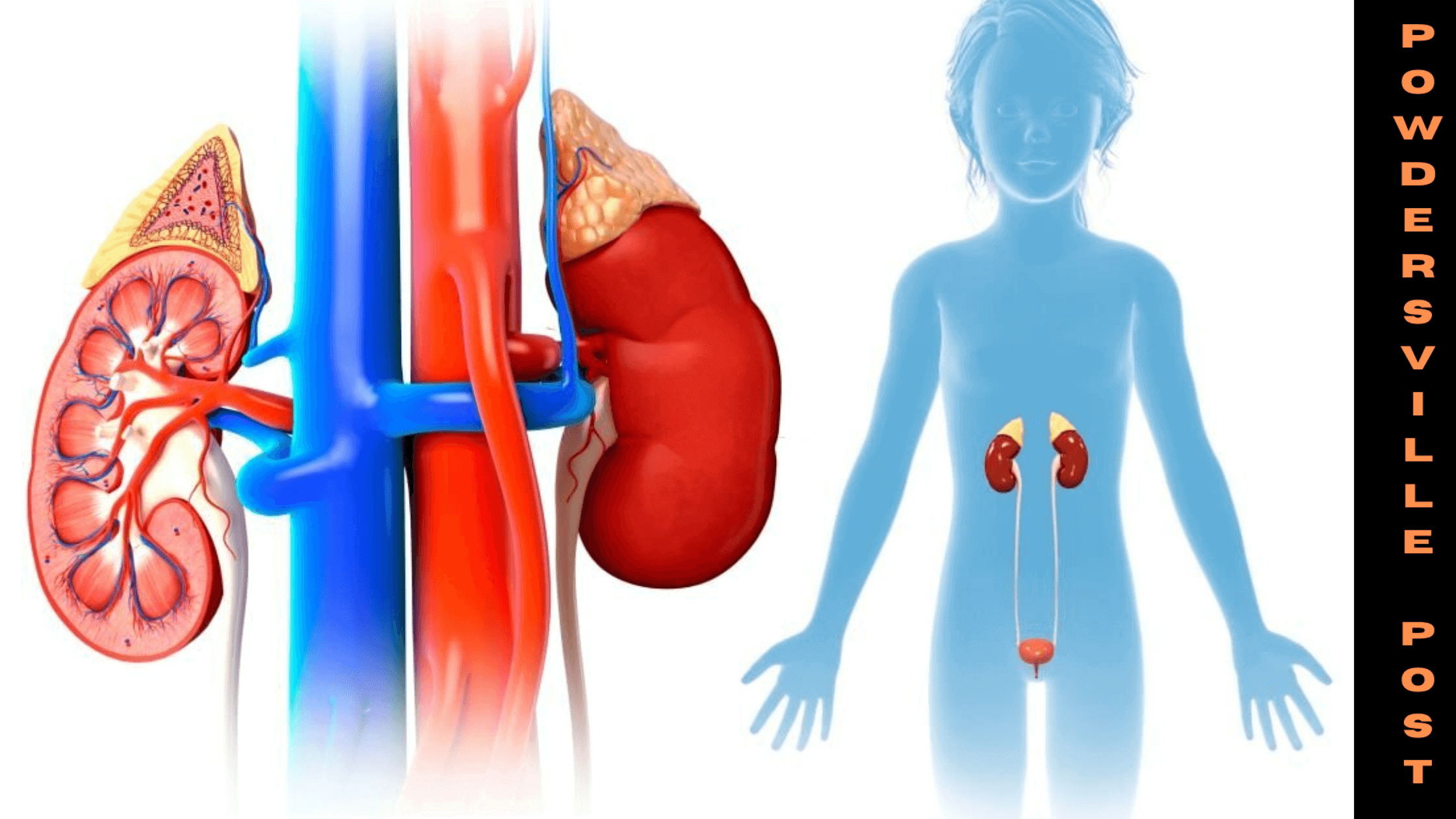 Hereditary Predisposition Key Factor For Kidney Tumor In Children