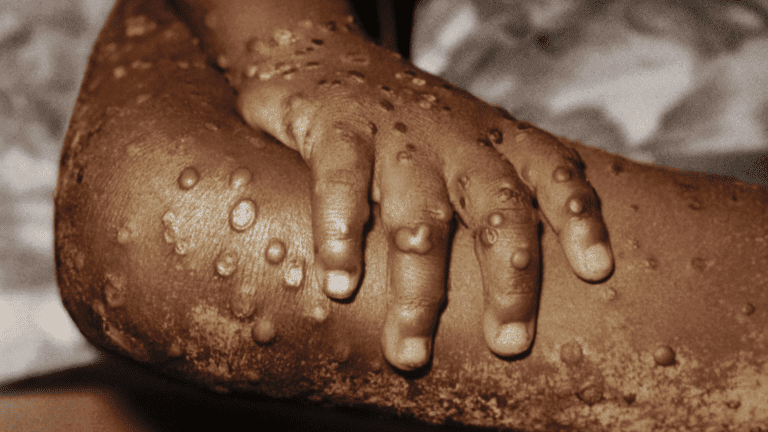 Causes And Symptoms Of MonkeyPox: Should You Be Worried?