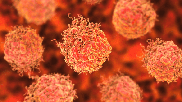 Common Subtype Of Prostate Cancer Is Identified By Cornell Scientists!