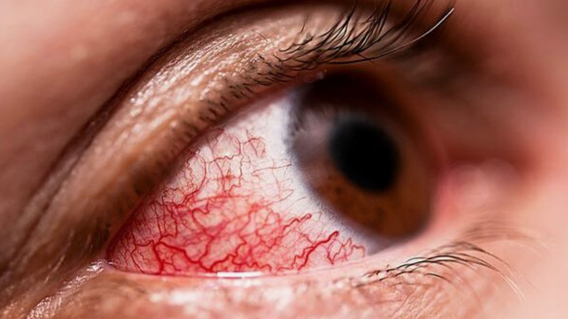 Europe The Deadly Eye-Bleeding Virus 