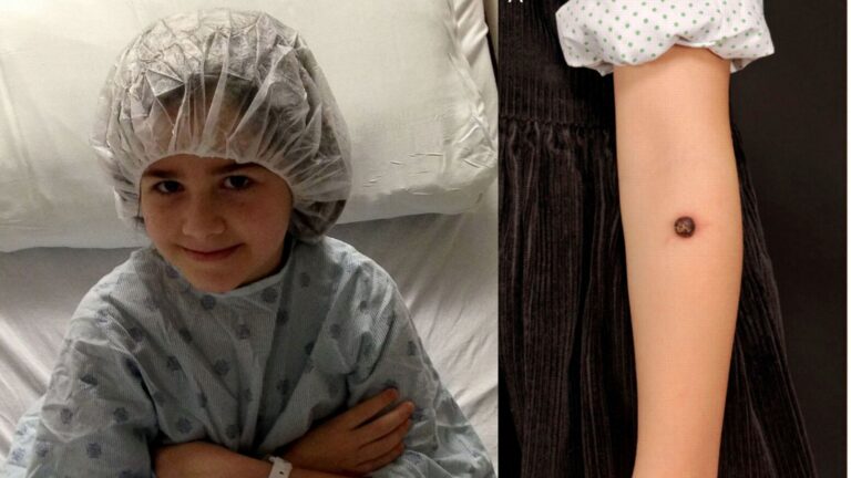 Finland Sees An Increase In Pediatric And Adolescent Melanoma!