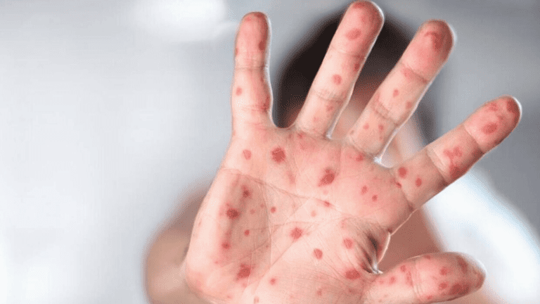 Monkeypox: Chance To Become New STD Virus In US!!