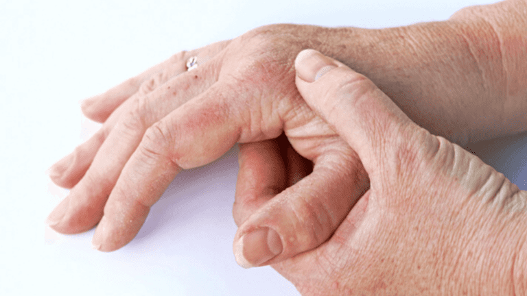 Psoriatic Arthritis: Treatments Are Not Getting Better Results!