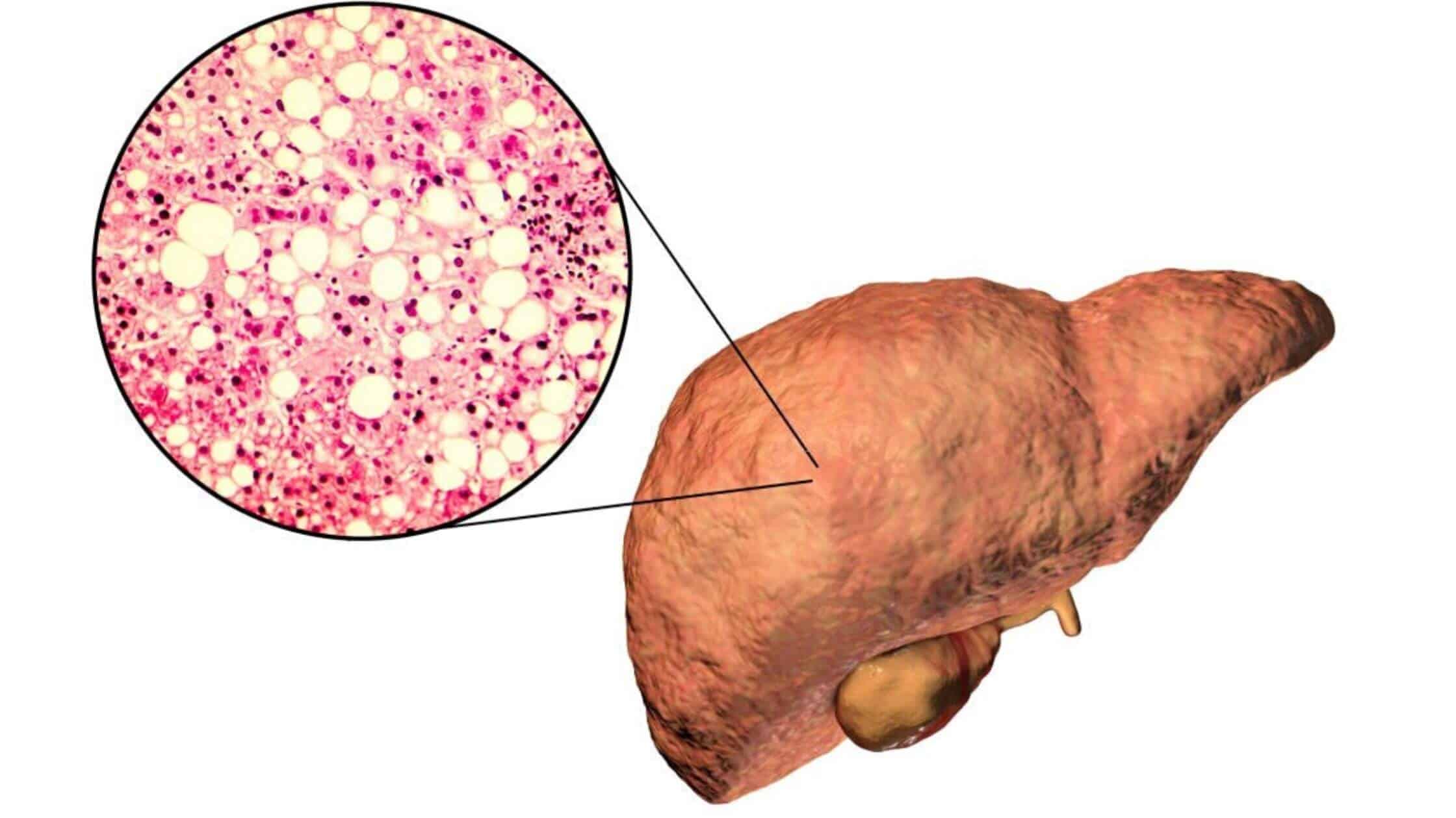 A Powerful Vitamin That May Treat Advanced Forms Of Fatty Liver Disease How