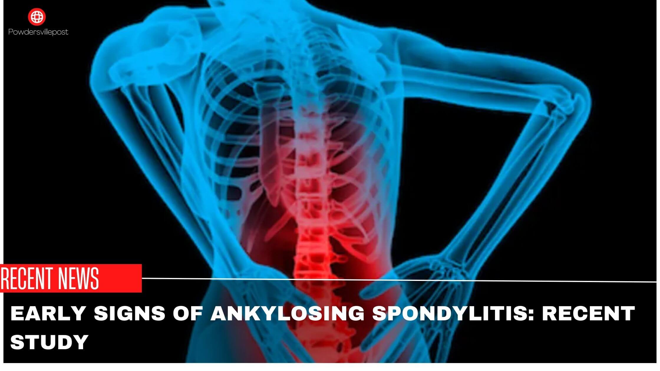 Early Signs Of Ankylosing Spondylitis Recent Study