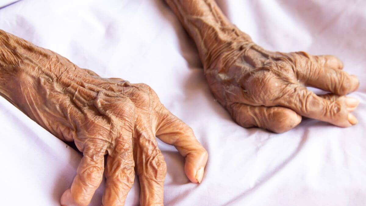 Rheumatoid arthritis