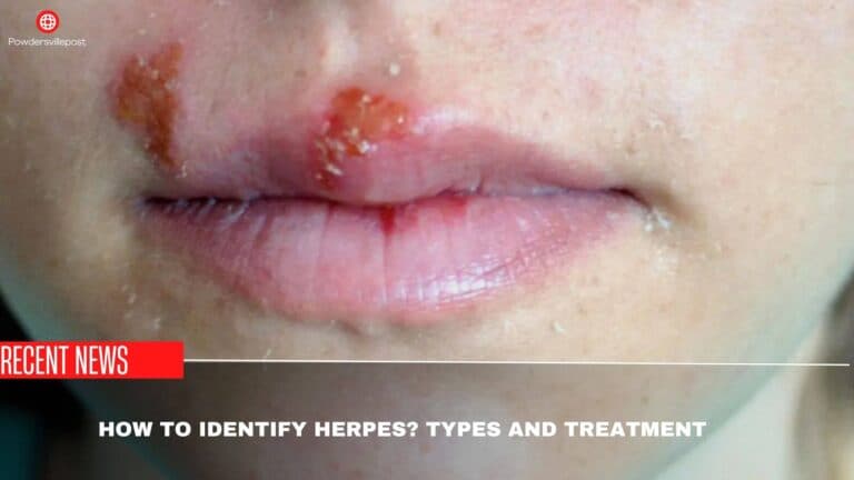 What Is Herpes? Types And Treatment