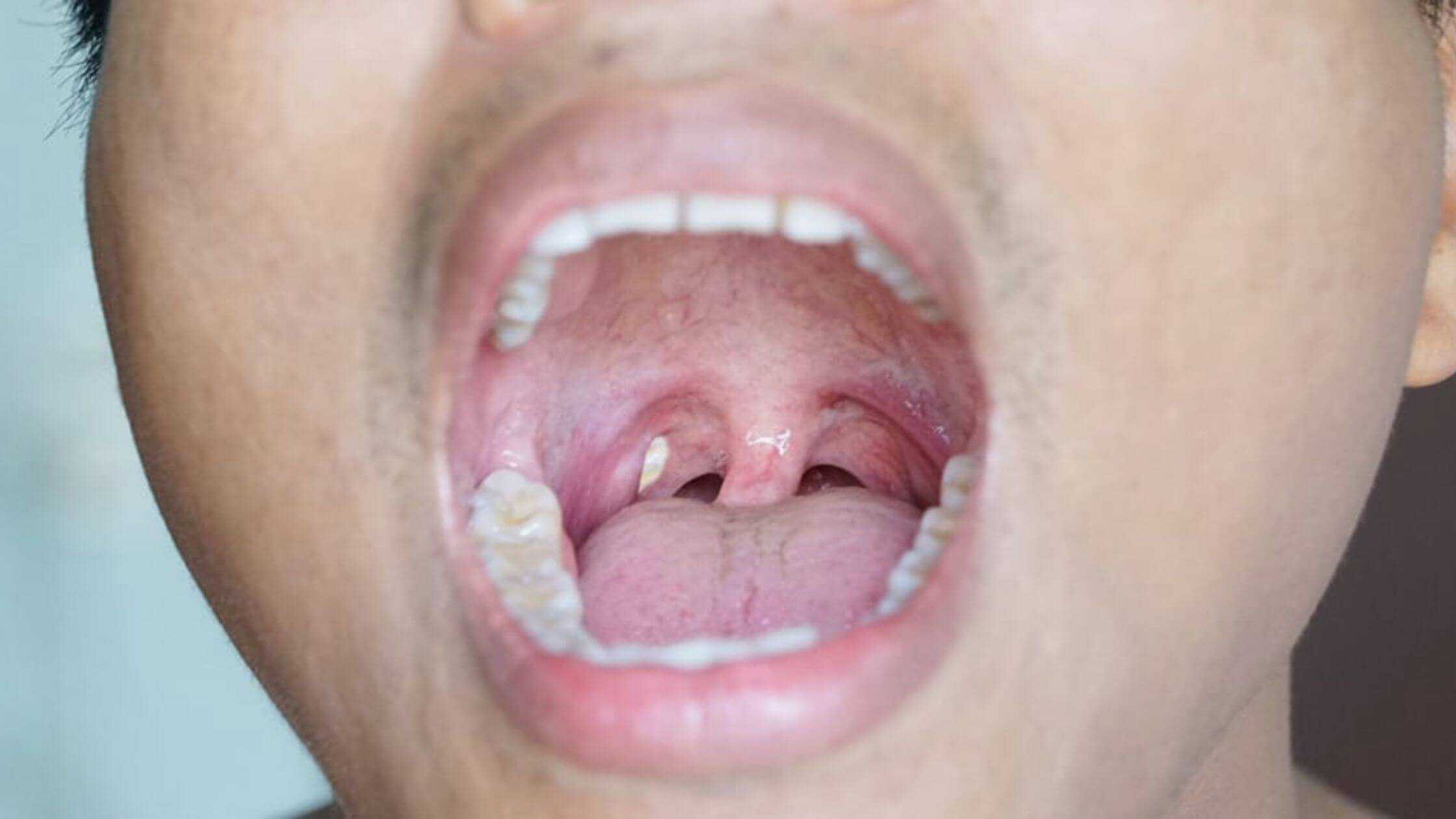 Is It Good To Remove Tonsil Stones How To Get Rid Of It