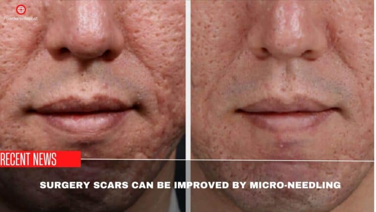 Surgery Scars Can Be Improved By Micro-Needling- Researchers Finding!