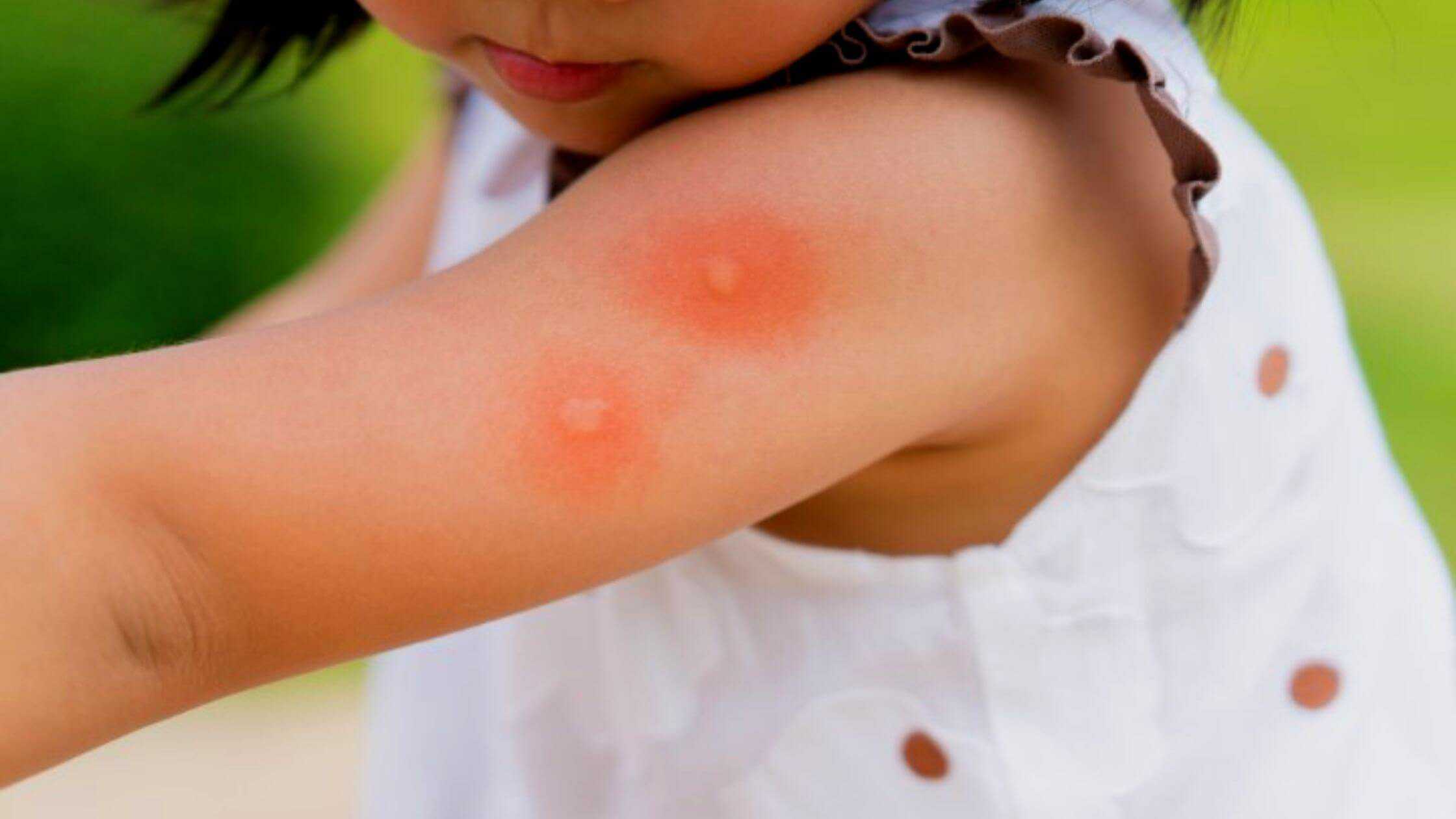 What Are The Reasons You Get So Many Mosquito Bites?