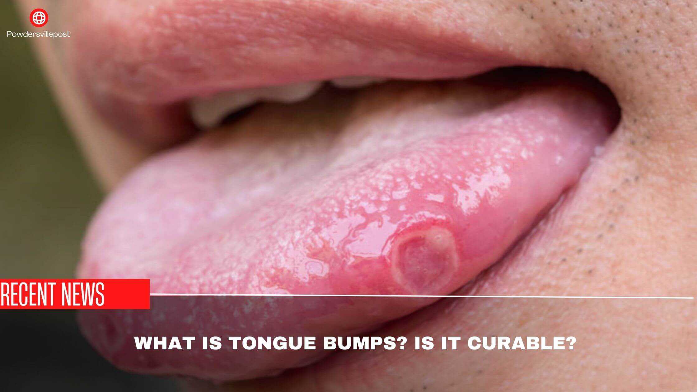 What Is Tongue Bumps Is It Curable