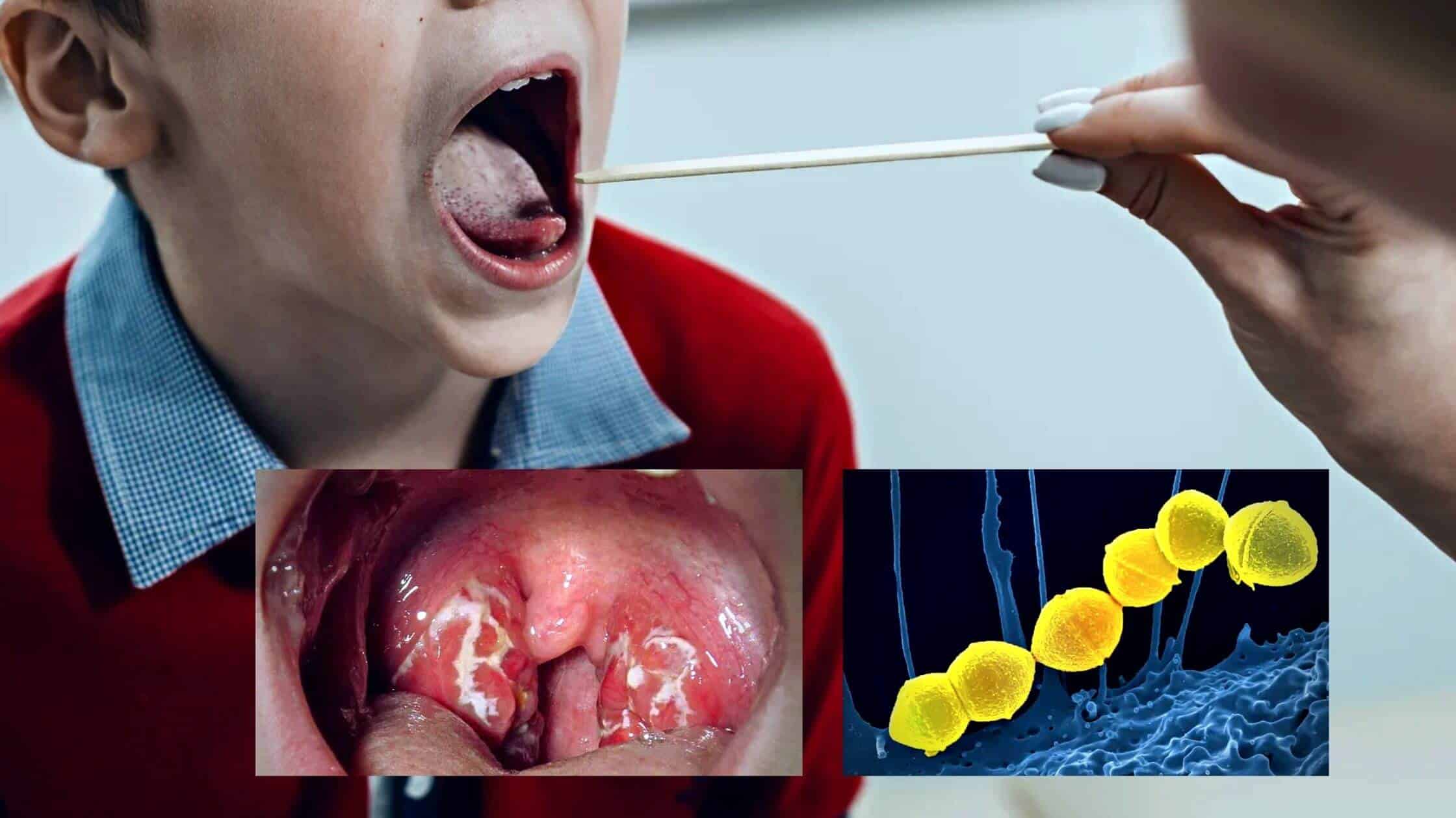 Strep A: Common Bacteria Cause Six Infant Deaths In The UK